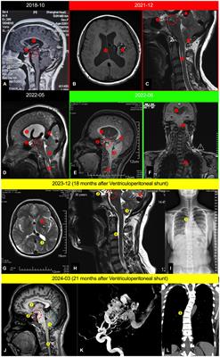 Unveiling the domino effect: a nine-year follow-up on pentalogy of central nervous system induced by a large unruptured cerebral arteriovenous malformation: a case report and literature review